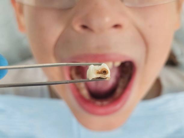 Best Cracked Tooth Emergency Dentist  in Poughkeepsie, NY